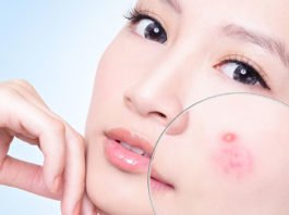 7 cách giảm sưng mụn tại nhà cho da mịn màng 7 cách giảm sưng mụn tại nhà cho da mịn màng