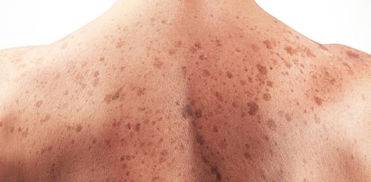 9 biểu hiện của bệnh ung thư da không nên xem thường biểu hiện ung thư da