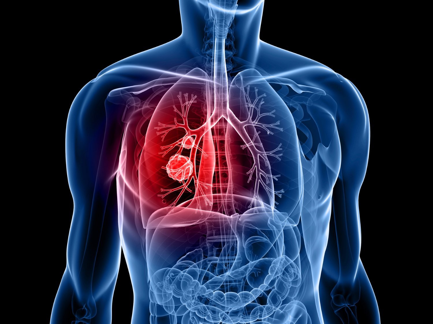 8 dấu hiệu ung thư phổi giai đoạn đầu cần nhận biết để điều trị