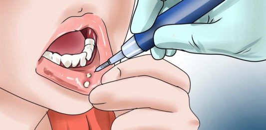 7 cách trị bệnh lở miệng ở người lớn đơn giản và hiệu quả bệnh nhiệt miệng
