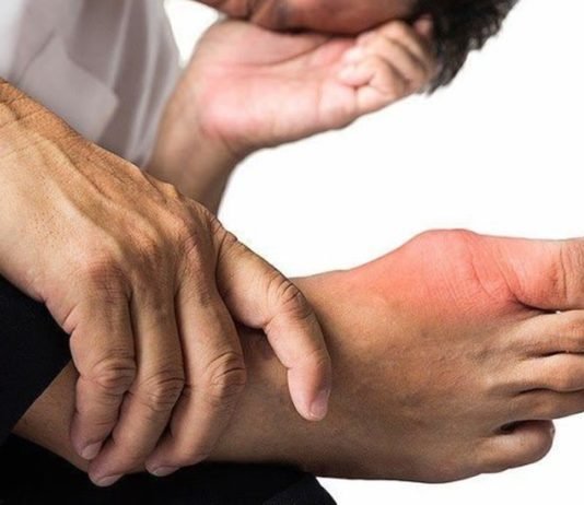 5 triệu chứng bệnh gút gây đau đớn cho người bệnh Bệnh gút