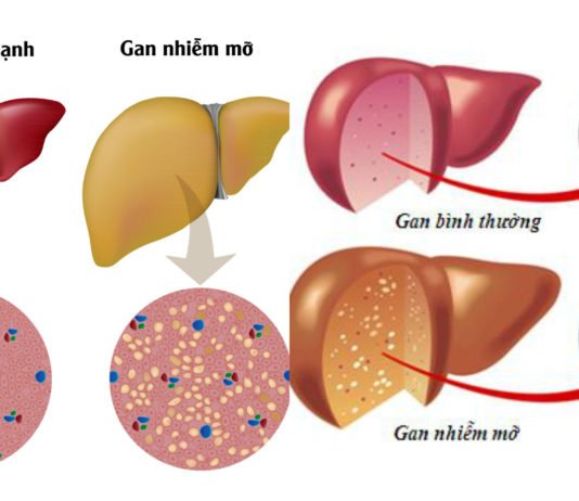Gan nhiễm mỡ