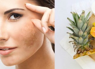 Trị nám da từ thiên nhiên