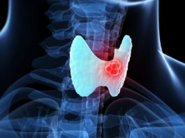 Ung thư tuyến giáp