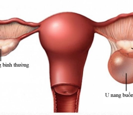 u nang buồng trứng