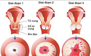 Ung thư cổ tử cung