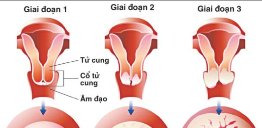 Ung thư cổ tử cung