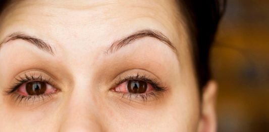 Triệu chứng đau mắt đỏ