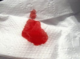 Trị đi ngoài ra máu tại nhà bằng 5 phương pháp cực kỳ đơn giản Đi ngoài ra máu