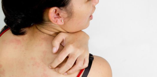 Dị ứng thời tiết