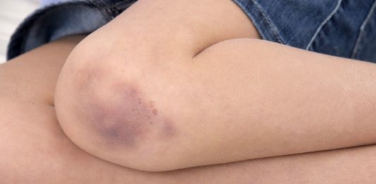 Bị bầm tím không rõ nguyên nhân: Liệu có nguy hại tới sức khỏe? Vết bầm tím