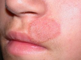 Cách chữa hắc lào hiệu quả, chống lây lan và không để lại sẹo Bệnh hắc lào