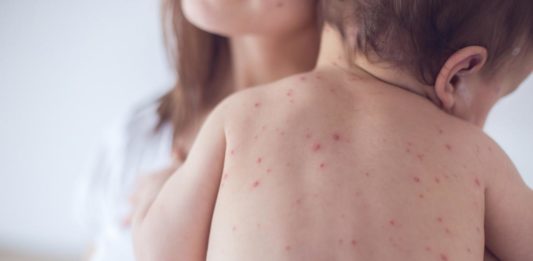 Triệu chứng bệnh sởi cha mẹ cần biết để bảo vệ con khỏi biến chứng nguy hiểm Triệu chứng bệnh sởi