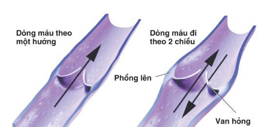 Triệu chứng suy giãn tĩnh mạch