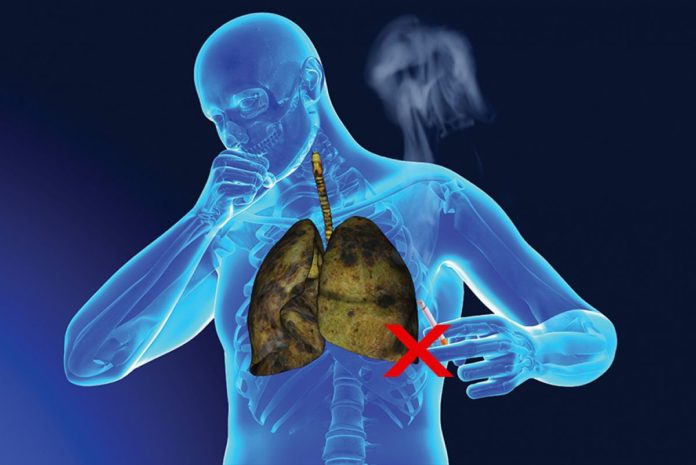 thuốc lá gây ung thư phổi