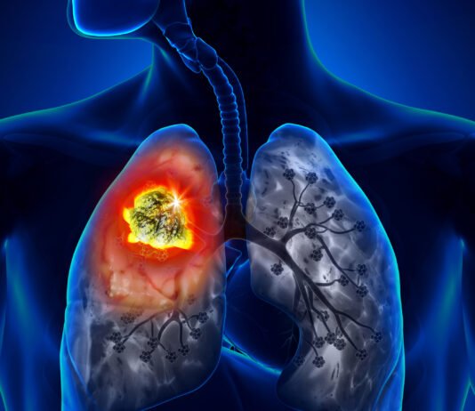 7 nguyên nhân ung thư phổi không ngờ tới ung thư phổi