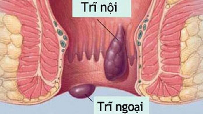 trĩ nội ngoại