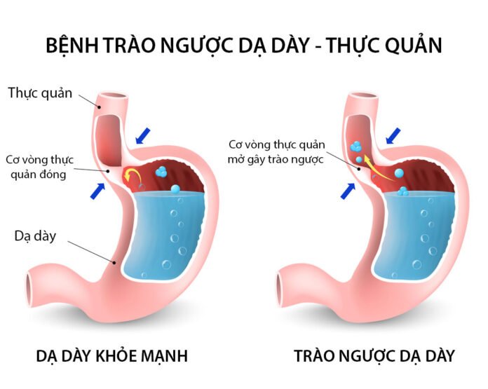 Cơ thắt thực quản