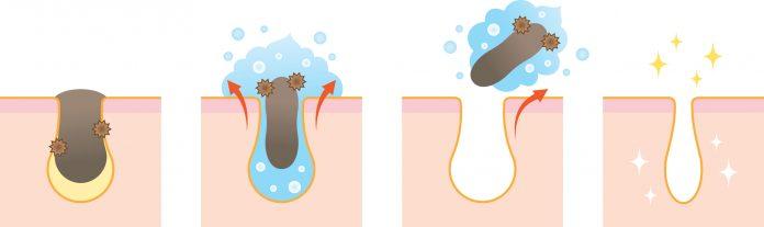 Salicylic acid có khả năng làm sạch sâu các lỗ chân lông bị bít tắc (ảnh internet)