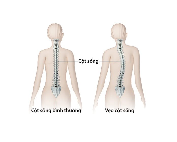 cong vẹo cột sống