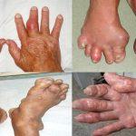 bệnh gout có khỏi không