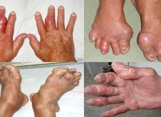 bệnh gout có khỏi không