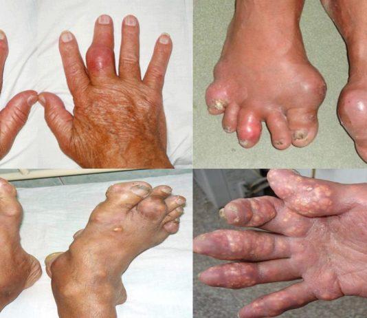 Bệnh gout có chữa khỏi được không? Nguyên nhân gây bệnh là gì? bệnh gout có khỏi không