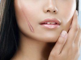 Bị sẹo nên kiêng ăn những gì