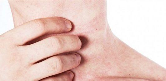 bệnh sởi ở người lớn