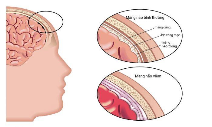 viêm não Nhật Bản