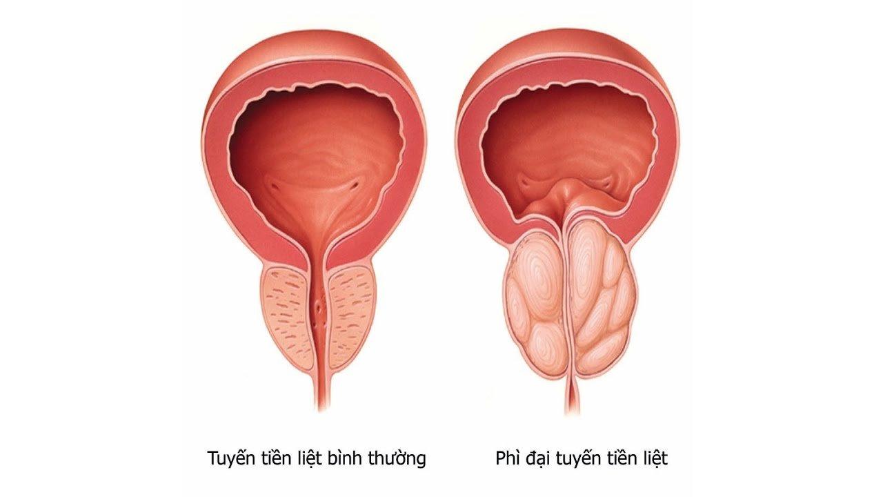 Phì đại tuyến tiền liệt