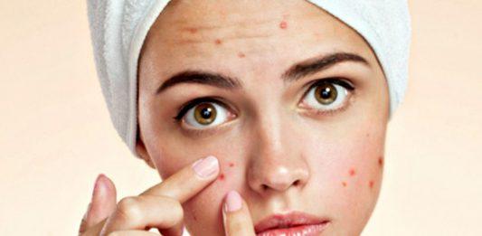 Mụn ẩn có thực sự nan giải như bạn tưởng?