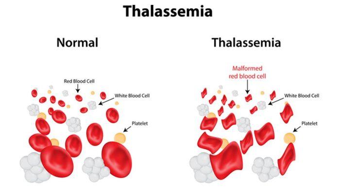 Thalassemia