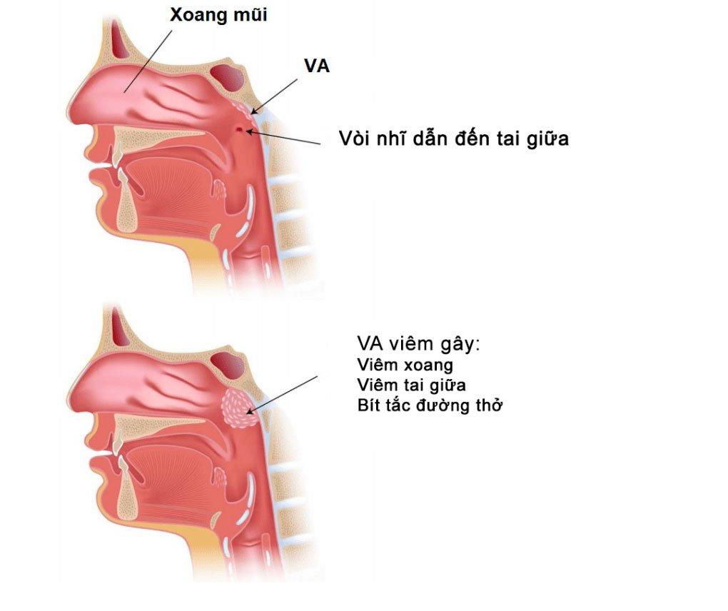 viêm VA