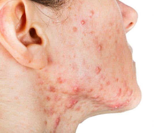 Mụn bọc với phần nhân mụn nằm sâu bên trong da cùng hình dáng như vết muỗi cắn nên mọi người thường không quá chú ý chơ tới khi tình trạng viêm nặng hơn, gây cảm giác đau đớn. (Ảnh: Internet)