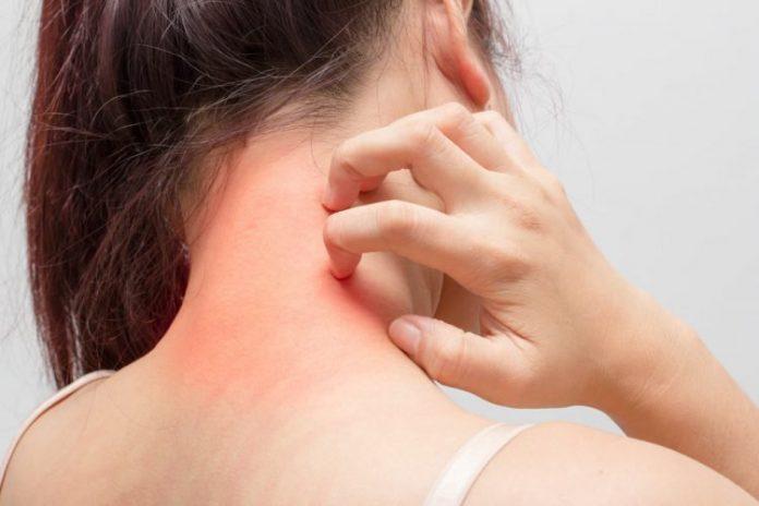 Da bị nóng và rát là hai biểu hiện đầu tiên khi bạn bị dị ứng da ( Nguồn: Internet )