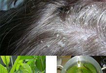 Cách trị nấm da đầu bằng lá ổi ( Nguồn: Internet)