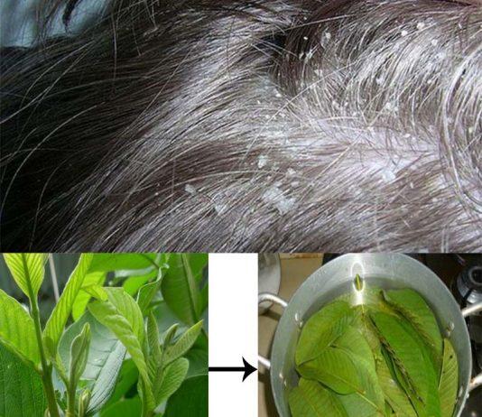 9 cách trị nấm da đầu nhanh và hiệu quả tại nhà Cách trị nấm da đầu bằng lá ổi ( Nguồn: Internet)