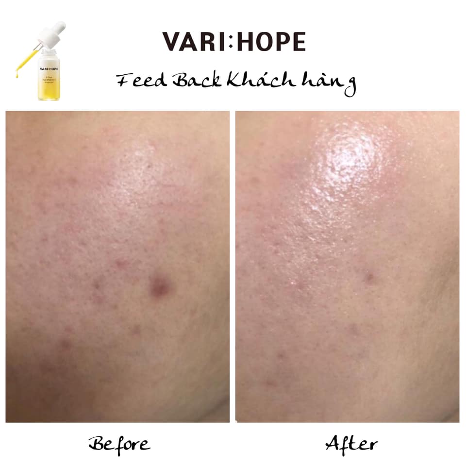 Vari:Hope 8 Days Pure Vitamin C Ampoule Plus cải thiện vết thâm mục, giúp da trắng sáng sau 8 ngày sử dụng (Nguồn: Internet).