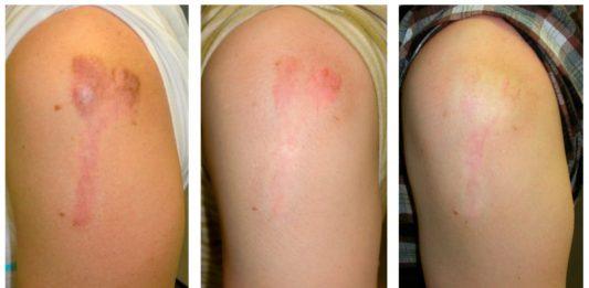 Cách trị sẹo lồi đơn giản tại nhà giúp làm mờ sẹo nhanh chóng