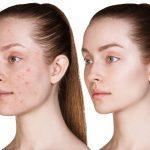 “Cẩm nang” về Salicylic Acid – Tất cả kiến thức bạn cần biết về thành phần này