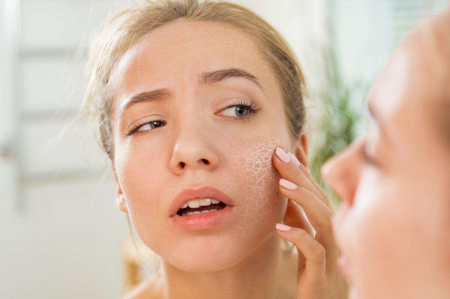Sử dụng Salicylic Acid có thể khiến da bạn bị khô và châm chích nhé. (Nguồn: Internet).