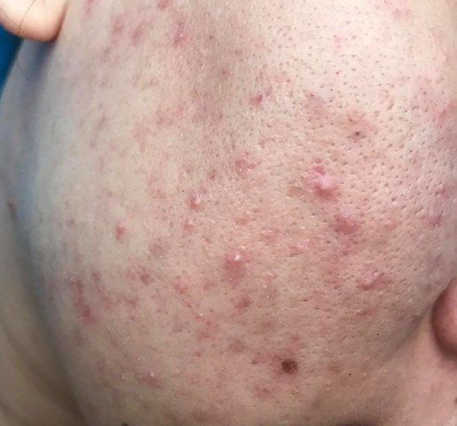 Teana Super Peptides Anti-Redness hiệu quả đối với các làn mụn sưng viêm, luôn bị ửng đỏ do tình trạng mụn kéo dài. (nguồn: Internet)