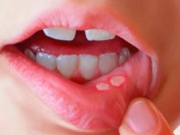Nhiệt miệng là gì và cách chữa trị (Ảnh Internet)