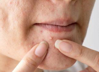 8 sai lầm khiến lỗ chân lông to lại càng to, gây mụn lại nhanh già trông thấy rõ