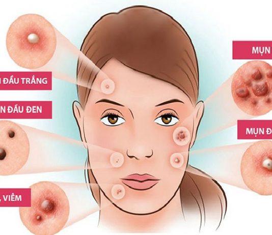 Cac-loai-mun-thuong-gap