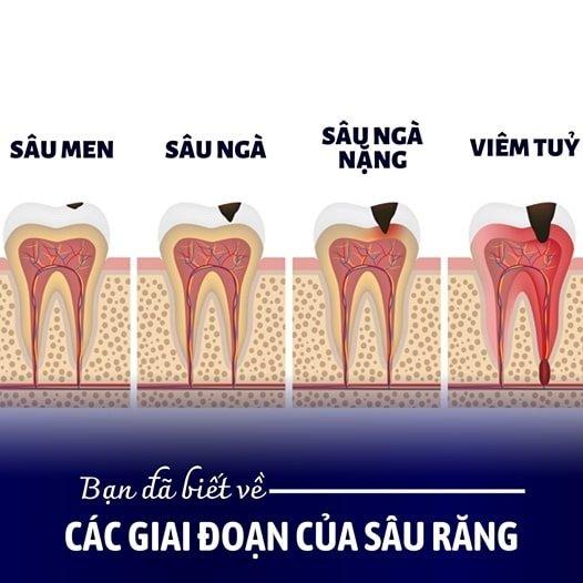 Sâu răng diễn tiến qua các giai đoạn từ ngoài vào trong: sâu men, sâu ngà rồi viêm tủy (Ảnh: Internet).