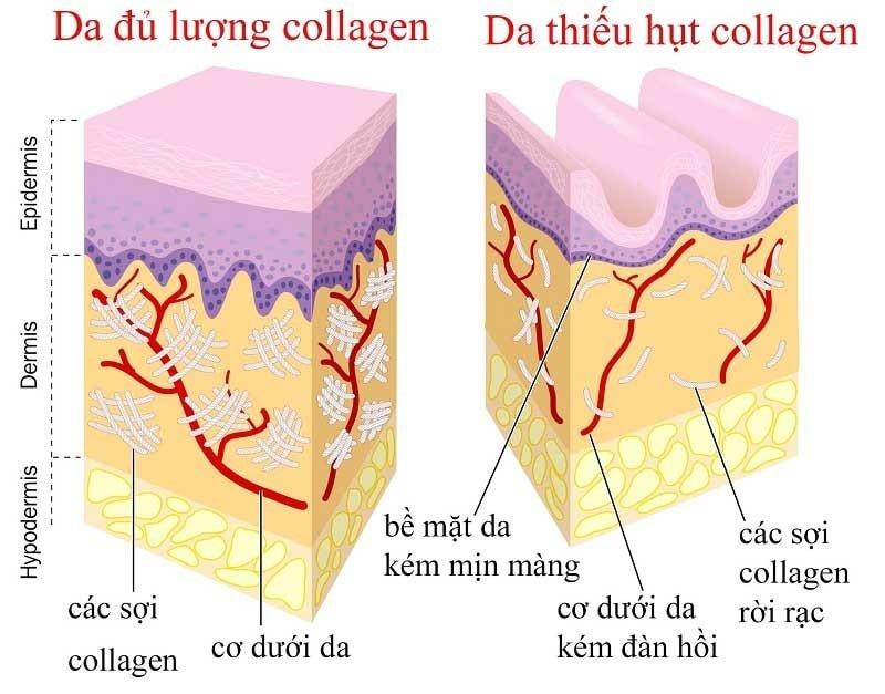 Thiếu hụt collagen là nguyên nhân chủ yếu khiến da lão hóa sớm và kém sức sống. (Nguồn: Internet)