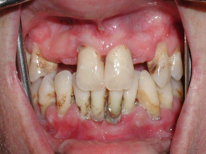 Các mô quanh răng bị hủy hoại nặng nề do viêm nha chu (Nguồn: Internet).