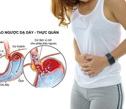 Bệnh trào ngược dạ dày thực quản: Tất cả những điều bạn cần biết
